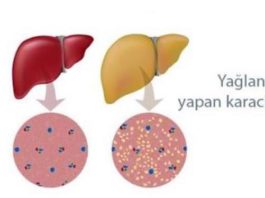 Karaciğer Yağlanması Nedir